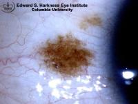 Conjunctival nevus at the juxtalimbal area.
